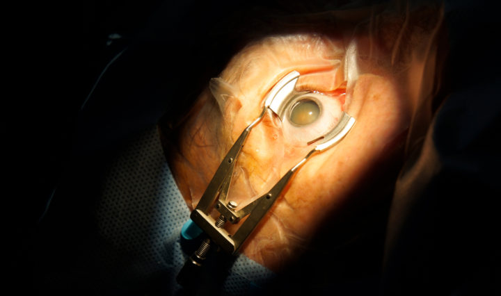 a patient gets cataract surgery at UTHSC's Hamilton Eye Institute