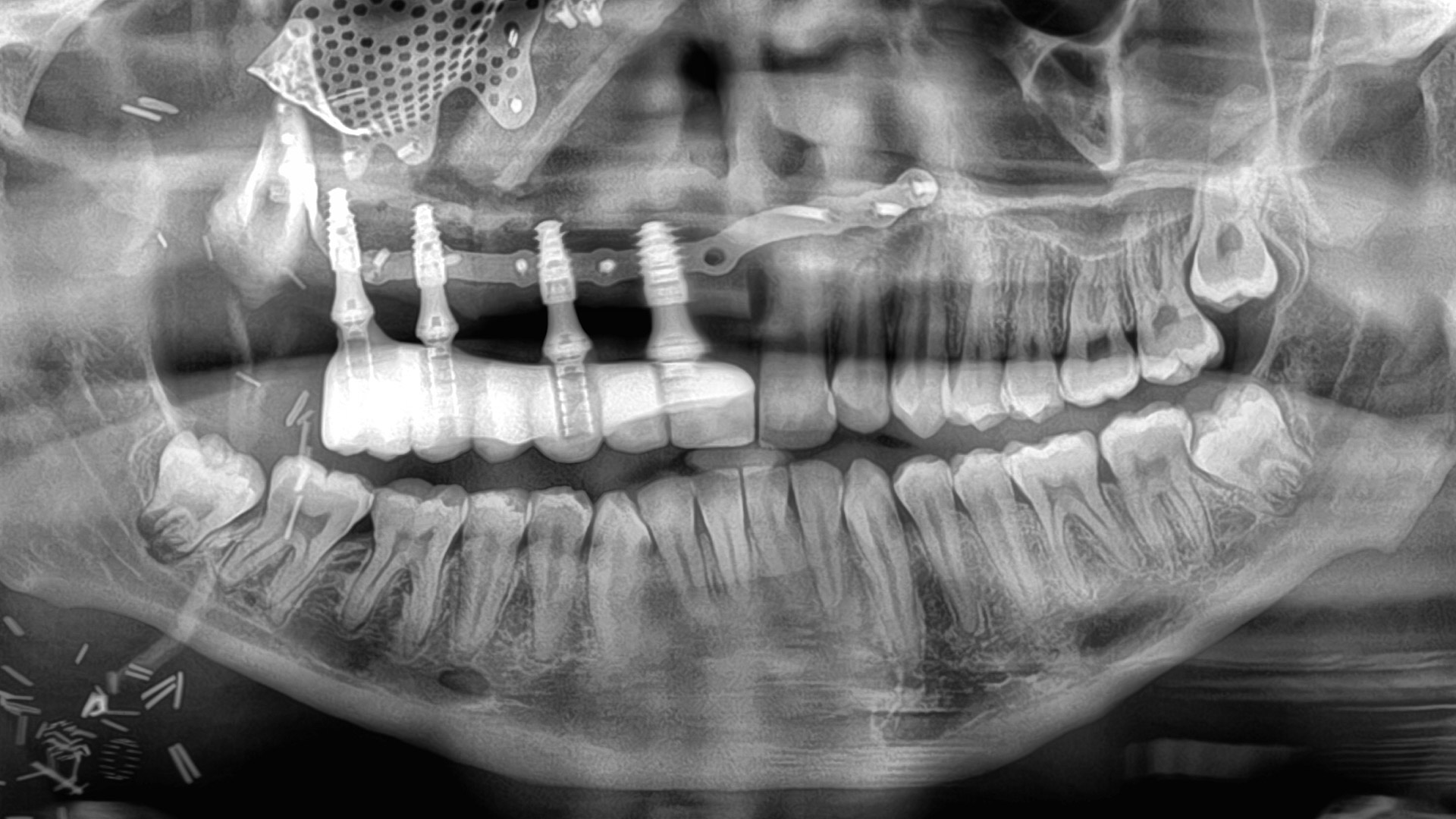 X-ray of a person's jaw, showing facial reconstruction methods.